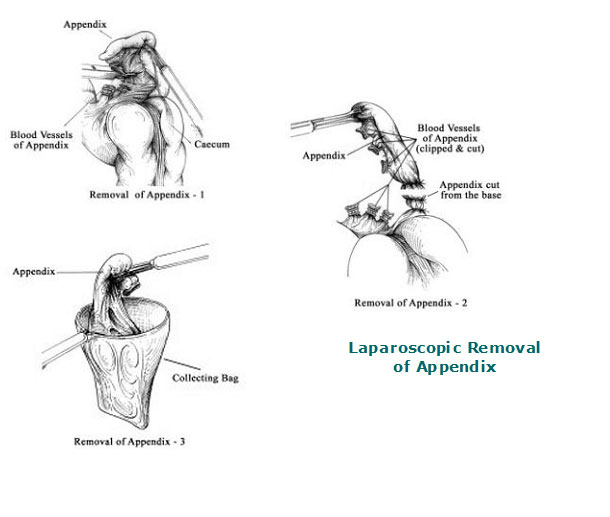 Laparoscopic Appendicectomy | Dr. Kapil Kochhar MBBS MS